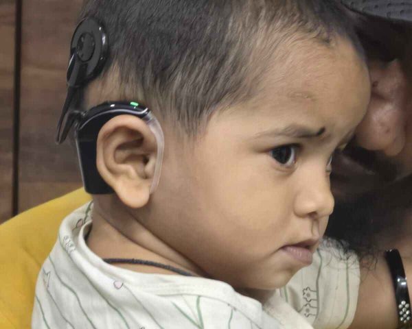 Cochlear Implant