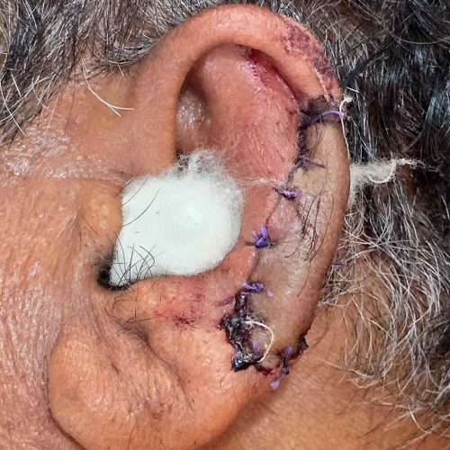 Cosmetic Ear Surgeries